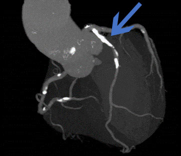Philips社製64列　Incisive CT