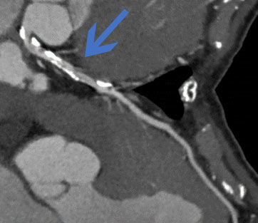 GE社製　Vivid S70N