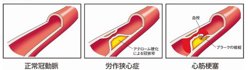 狭心症、心筋梗塞のしくみ