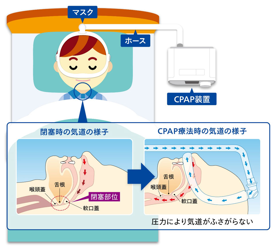CPAP療法